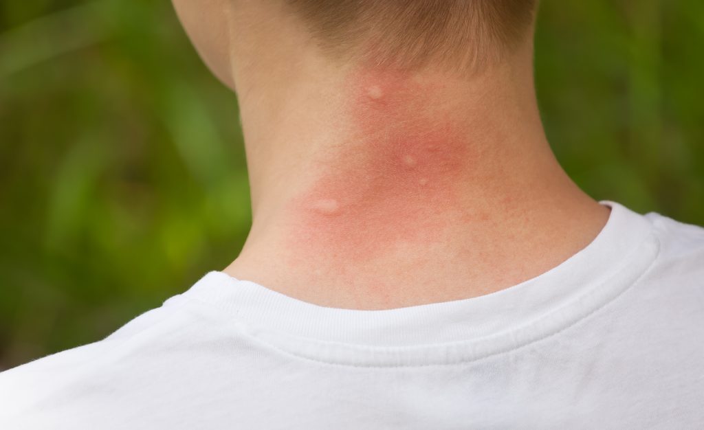 Battle against mosquitoes, mosquito bites, kids